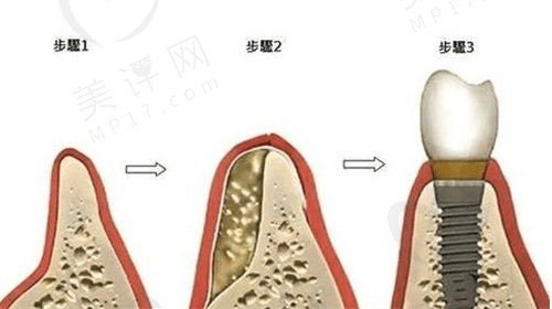 美国皓圣韩国奥齿泰种植体哪个好 美国皓圣韩国奥齿泰种植体哪个好