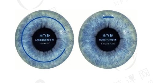 上海普瑞眼科做近视手术价格表 上海普瑞眼科做近视手术价格表