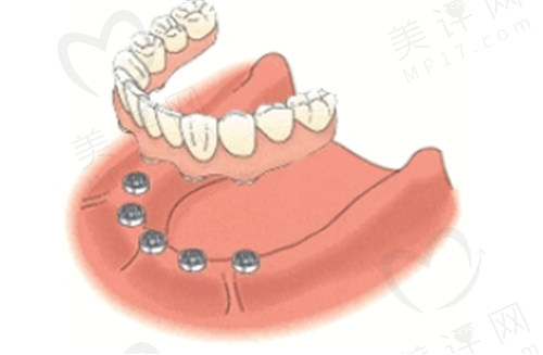 北京诚之康口腔医院全口种植牙价格 北京诚之康口腔医院全口种植牙价格