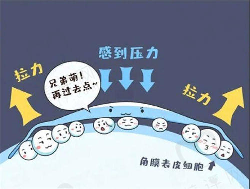 角膜塑形镜是什么 角膜塑形镜是什么