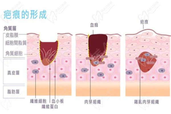 韩国疤痕修复技术到底有多好 韩国疤痕修复技术到底有多好