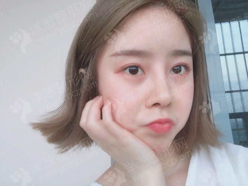 1629439682112422.jpg 术中.jpg