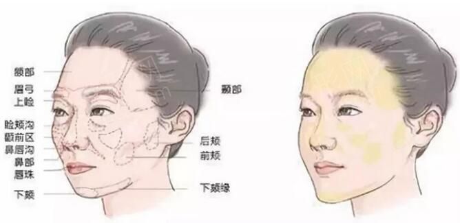 脂肪填充9.jpg